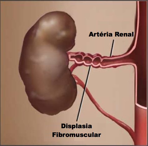 displasia-fibromuscular-cirurgiao-vascular-dr-daniel-benitti
