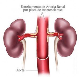 estenose-arteria-renal-cirurgiao-vascular-dr-daniel-benitti
