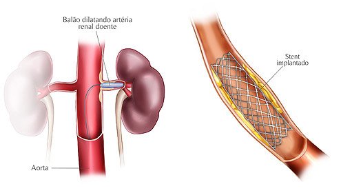 stent-arteria-renal-cirurgiao-vascular-dr-daniel-benitti