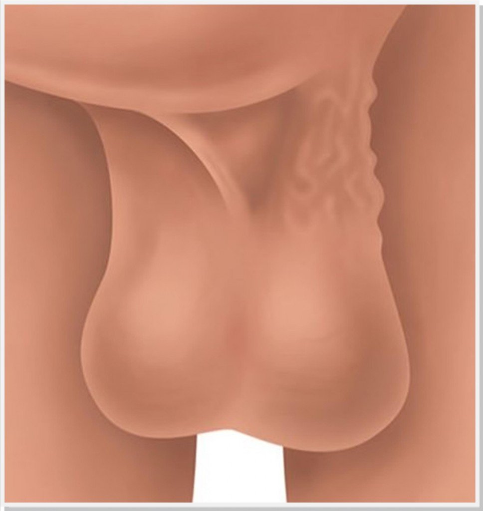 varicocele-dr-daniel-benitti-cirurgiao-vascular-campinas varicocele-dr-daniel-benitti-cirurgiao-vascular-campinas