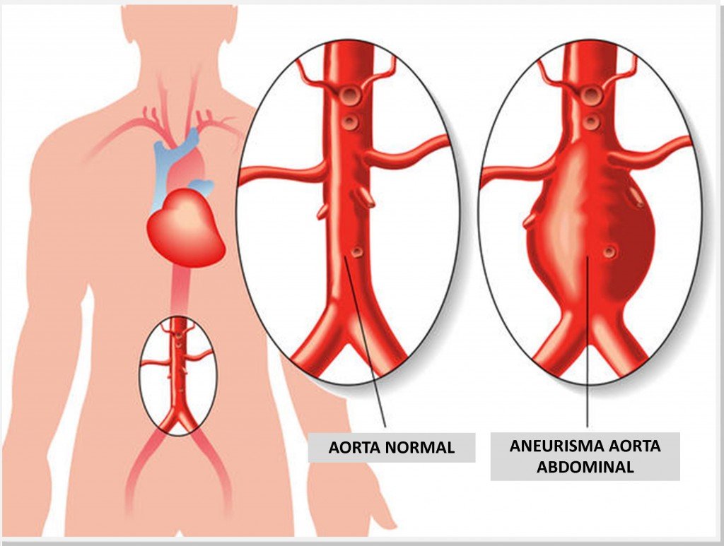 aneurisma-aorta-dr-daniel-benitti-cirurgiao-vascular-campinas aneurisma-aorta-dr-daniel-benitti-cirurgiao-vascular-campinas