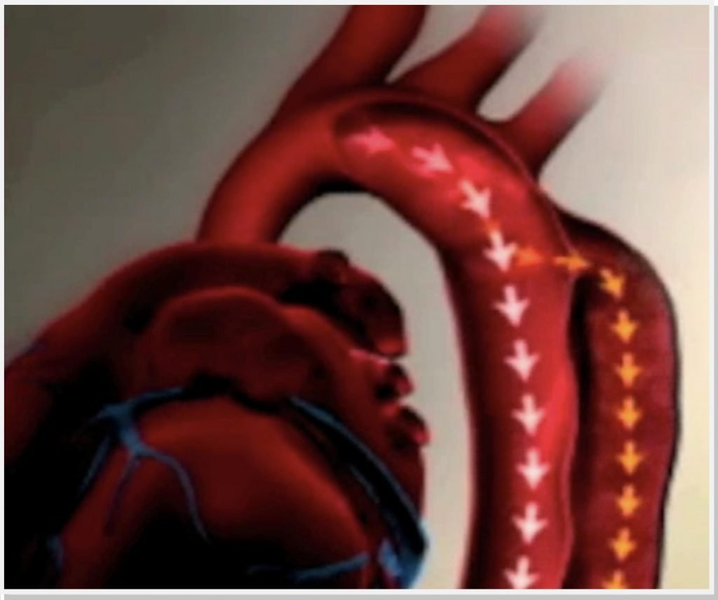 Modelo anatômico de aneurisma da aorta abdominal - 021 series