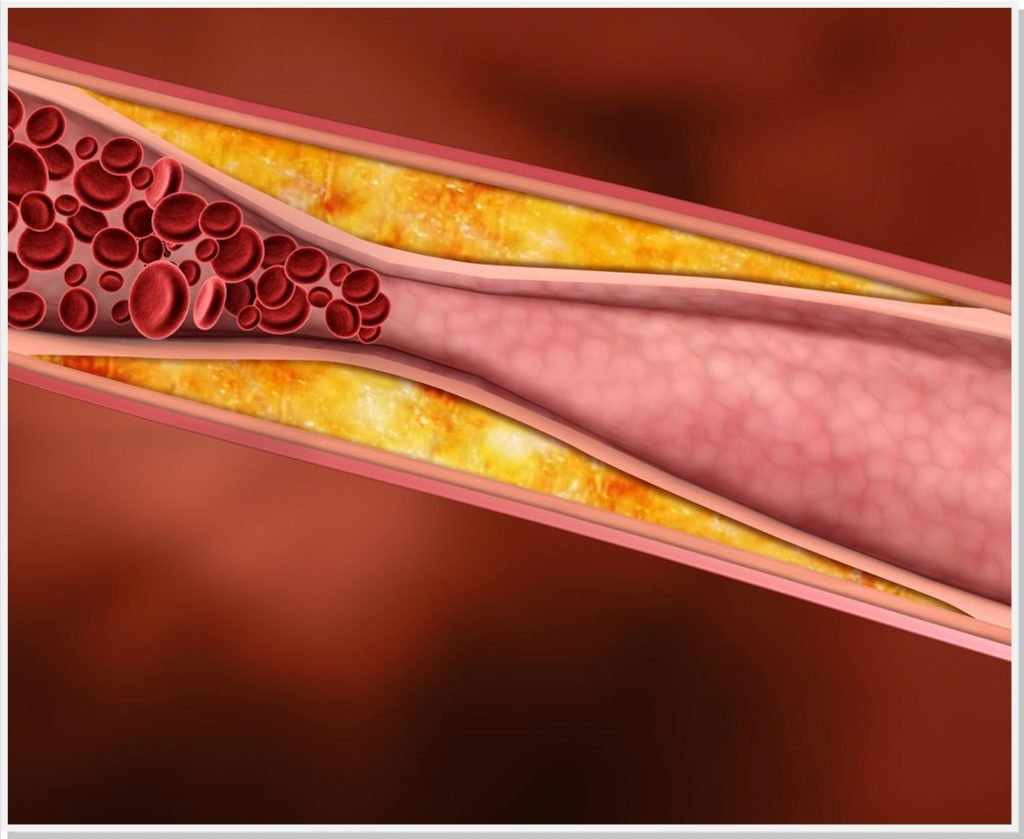 Dislipidemia-dr-daniel-benitti-cirurgiao-vascular-campinas Dislipidemia-dr-daniel-benitti-cirurgiao-vascular-campinas