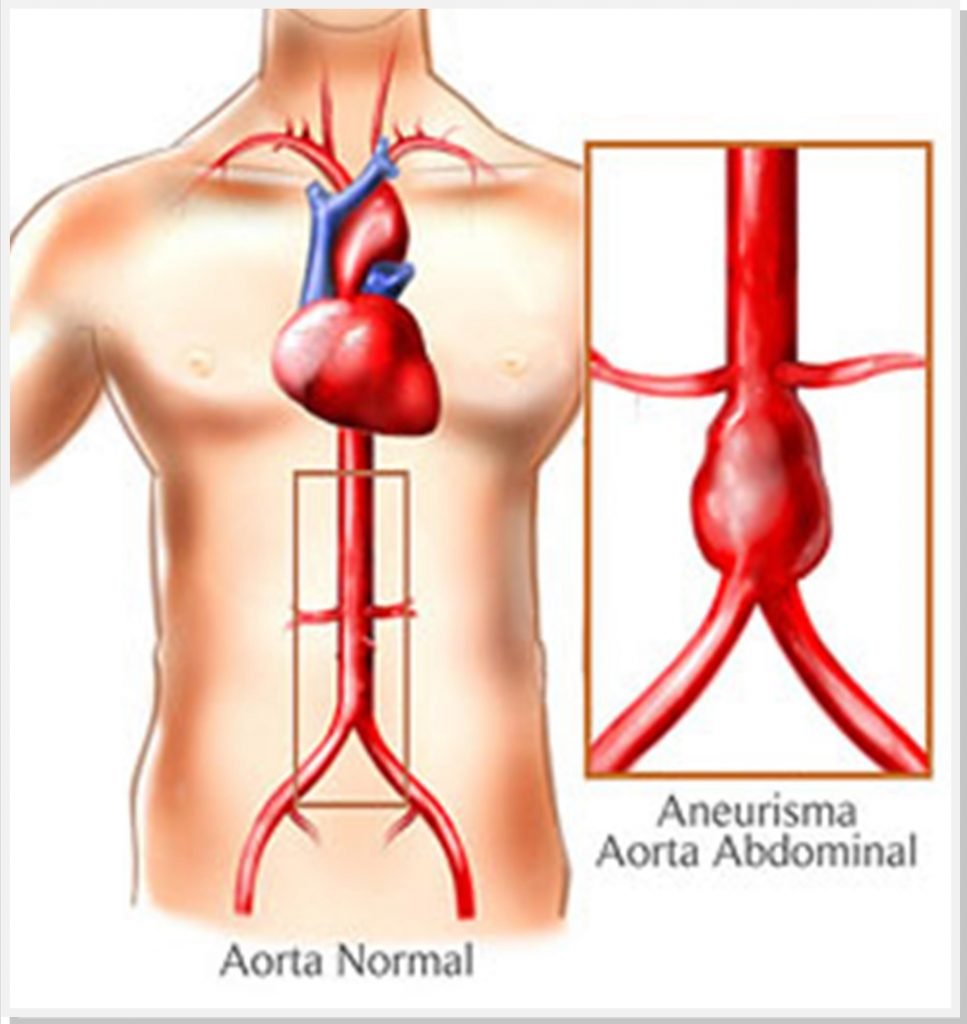 aneurisma-cirurgiao-vascular-dr-daniel-benitti aneurisma-cirurgiao-vascular-dr-daniel-benitti