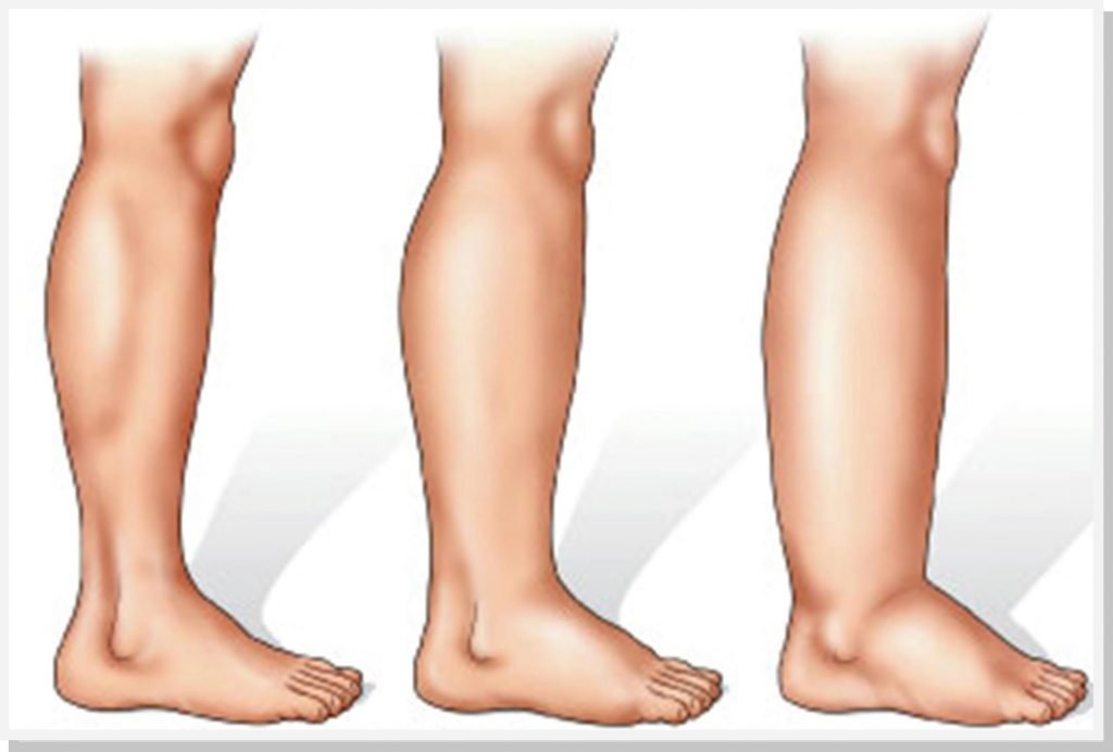 linfedema-dr-daniel-benitti-cirurgiao-vascular-campinas linfedema-dr-daniel-benitti-cirurgiao-vascular-campinas