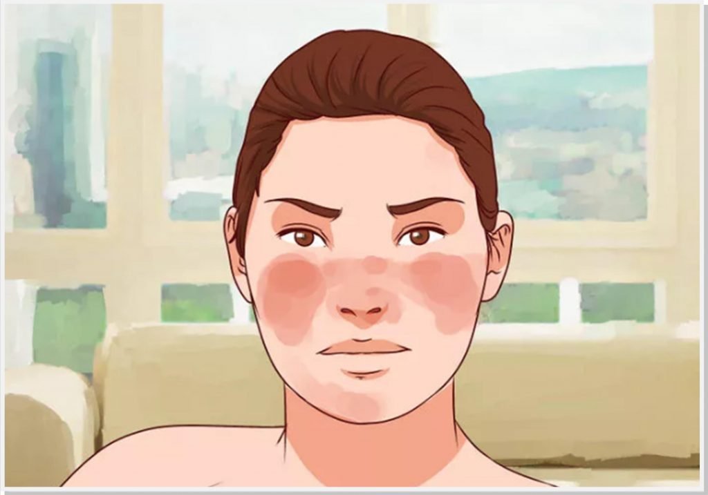 lupus-cirurgiao-vascular-campinas-dr-daniel-benitti lupus-cirurgiao-vascular-campinas-dr-daniel-benitti