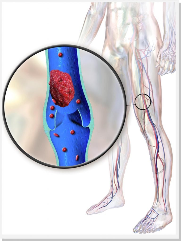 trombose-venosa-profunda-dr-daniel-benitti-cirurgiao-vascular-campinas trombose-venosa-profunda-dr-daniel-benitti-cirurgiao-vascular-campinas