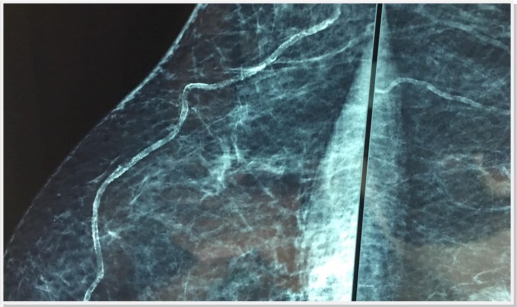 mamografia-saude-vascular-dr-daniel-benitti-cirurgiao-vascular-campinas-2 mamografia-saude-vascular-dr-daniel-benitti-cirurgiao-vascular-campinas-2