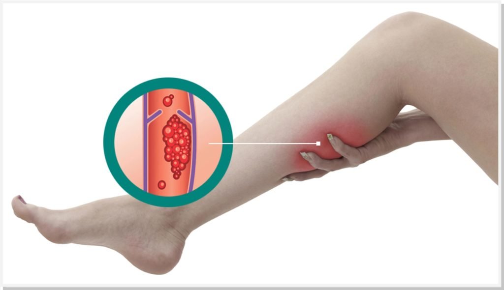 trombose-venosa-profunda-dr-daniel-benitti-cirurgiao-vascular trombose-venosa-profunda-dr-daniel-benitti-cirurgiao-vascular