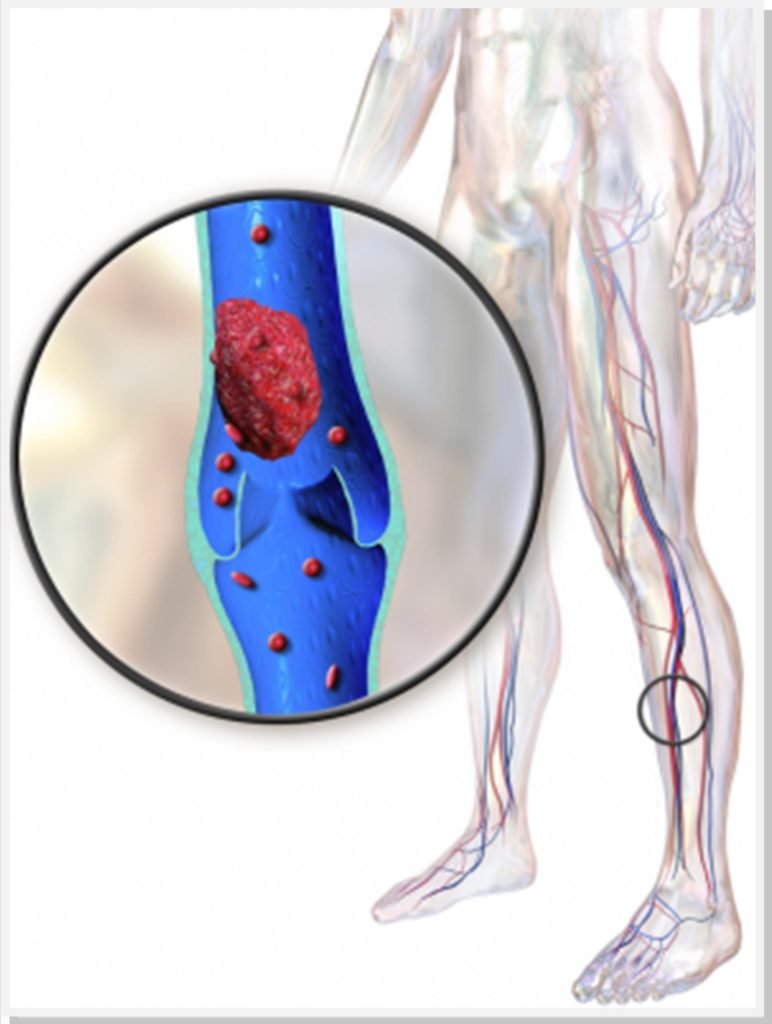 trombose-dr-daniel-benitti-cirurgiao-vascular-campinas trombose-dr-daniel-benitti-cirurgiao-vascular-campinas