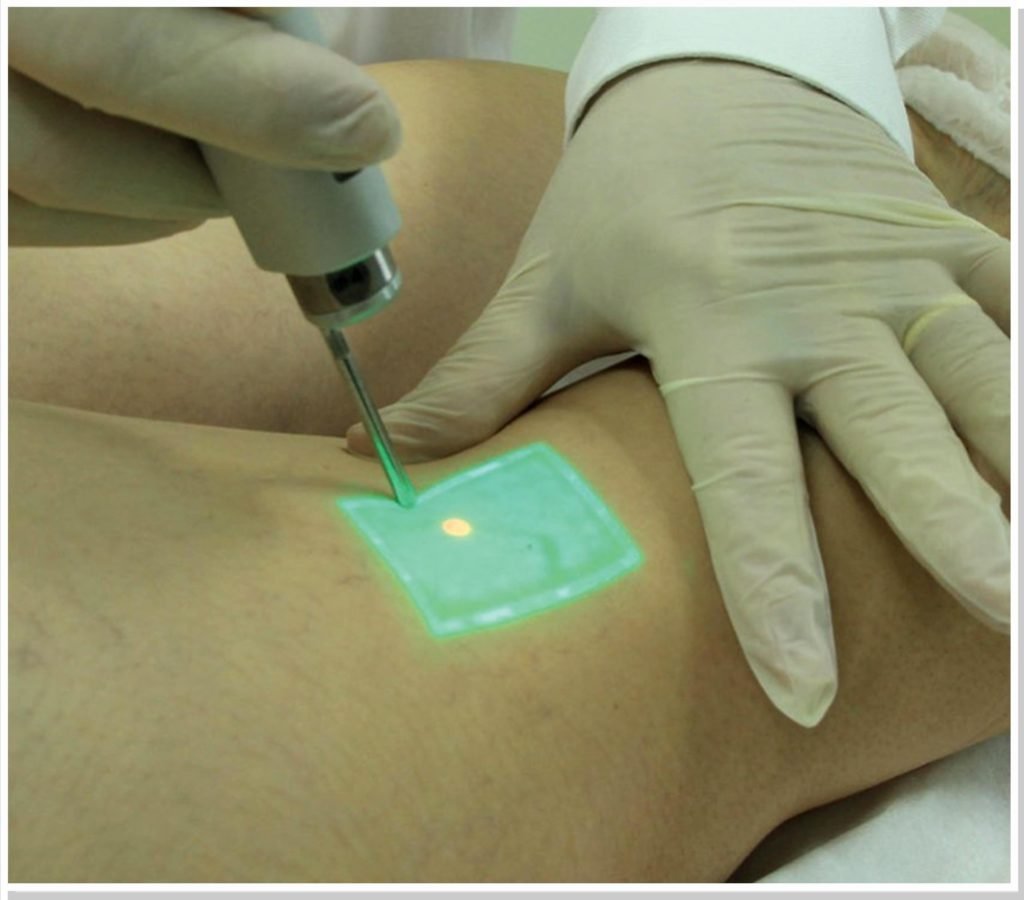 laser-varizes-laser-vasinhos-dr-daniel-benitti-cirurgiao-vascular laser-varizes-laser-vasinhos-dr-daniel-benitti-cirurgiao-vascular