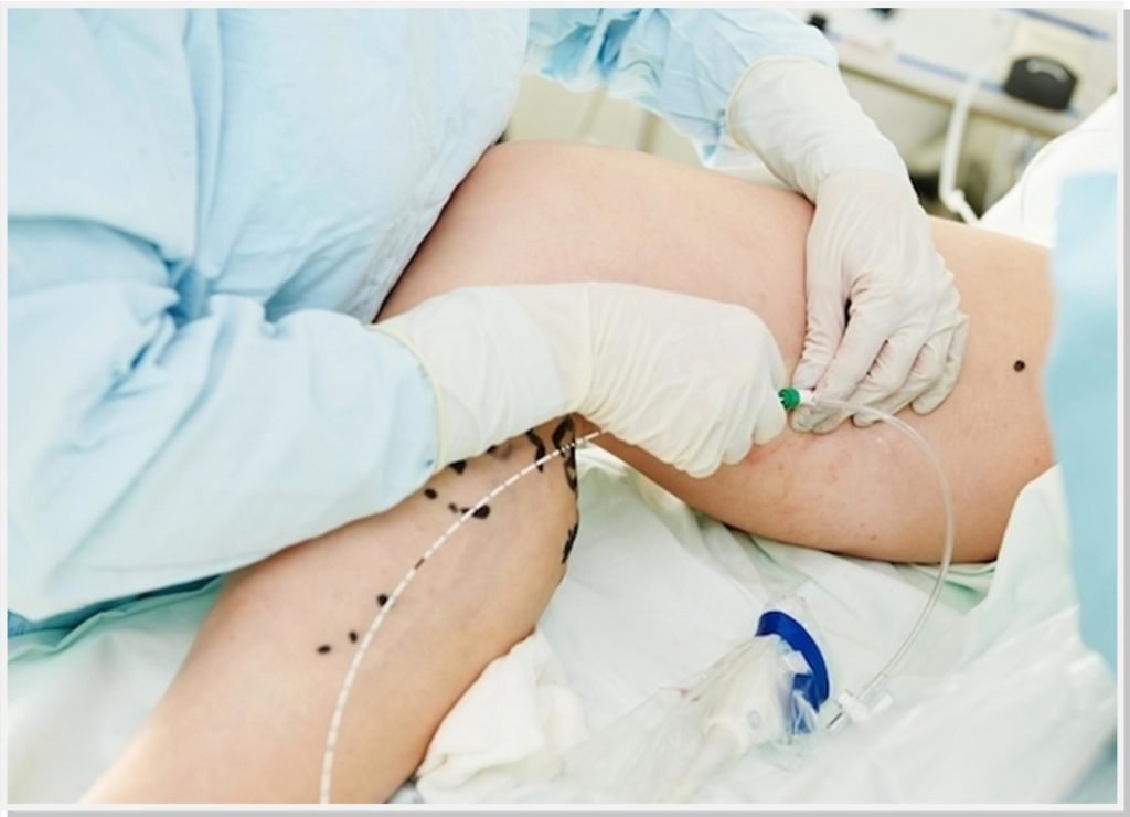 cirurgia-varizes-dr-daniel-benitti-cirurgiao-vascular cirurgia-varizes-dr-daniel-benitti-cirurgiao-vascular