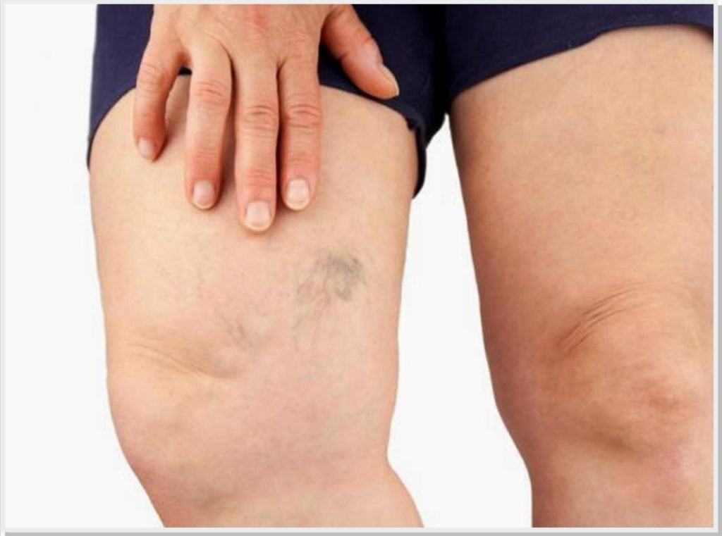tratamento-varizes-dr-daniel-benitti-cirurgiao-vascular-campinas tratamento-varizes-dr-daniel-benitti-cirurgiao-vascular-campinas