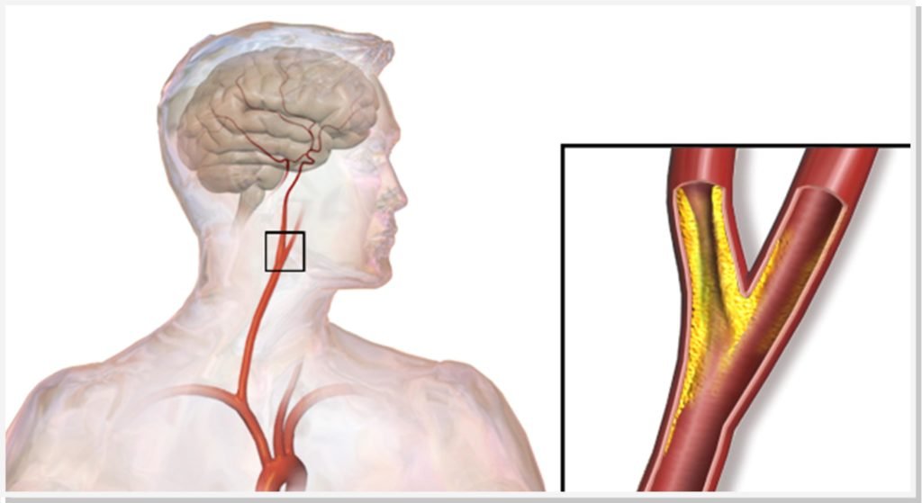 estenose-de-carotida-ultrassom-dr-daniel-benitti-cirurgiao-vascular-sp-campinas estenose-de-carotida-ultrassom-dr-daniel-benitti-cirurgiao-vascular-sp-campinas