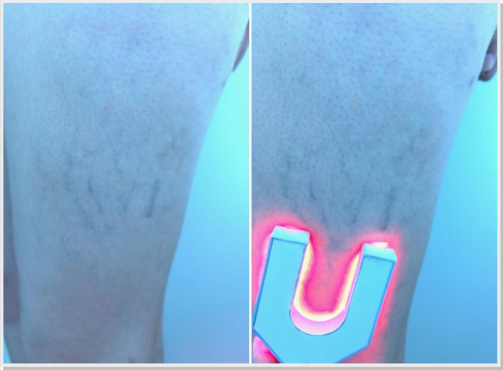 tratamento-vasinhos-veia-nutridora-dr-daniel-benitti-cirurgiao-vascular-sao-paulo-campinas tratamento-vasinhos-veia-nutridora-dr-daniel-benitti-cirurgiao-vascular-sao-paulo-campinas