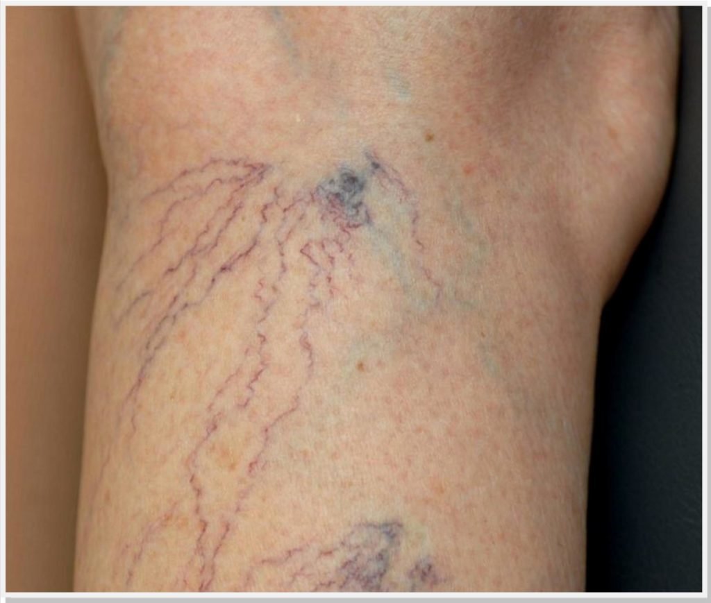 varizes-dr-daniel-benitti-cirurgiao-vascular-sao-paulo-campinas varizes-dr-daniel-benitti-cirurgiao-vascular-sao-paulo-campinas
