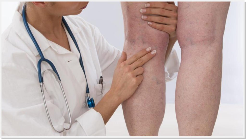 varizes-trombose-cirurgiao-vascular-dr-daniel-benitti-sao-paulo-campinas varizes-trombose-cirurgiao-vascular-dr-daniel-benitti-sao-paulo-campinas