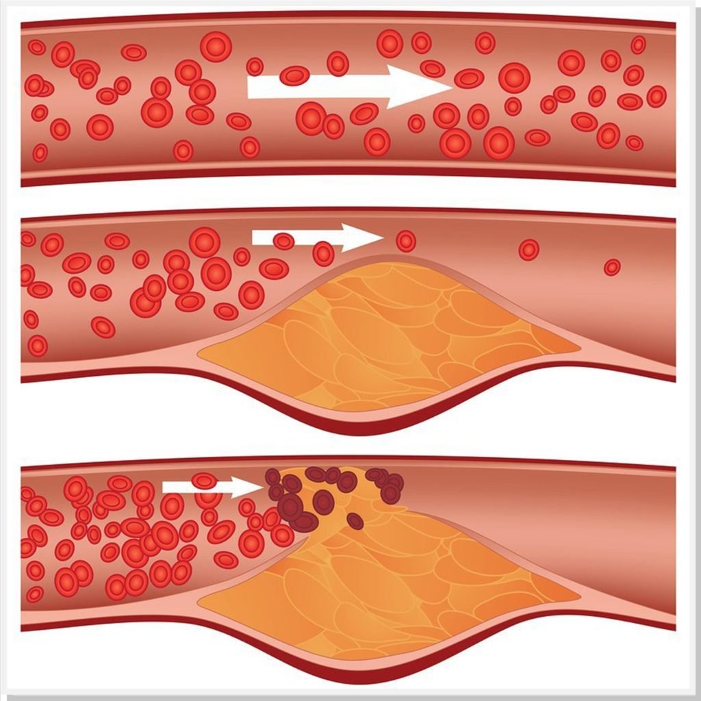 aterosclerose-dr-daniel-benitti-cirurgiao-vascular-sp-campinas
