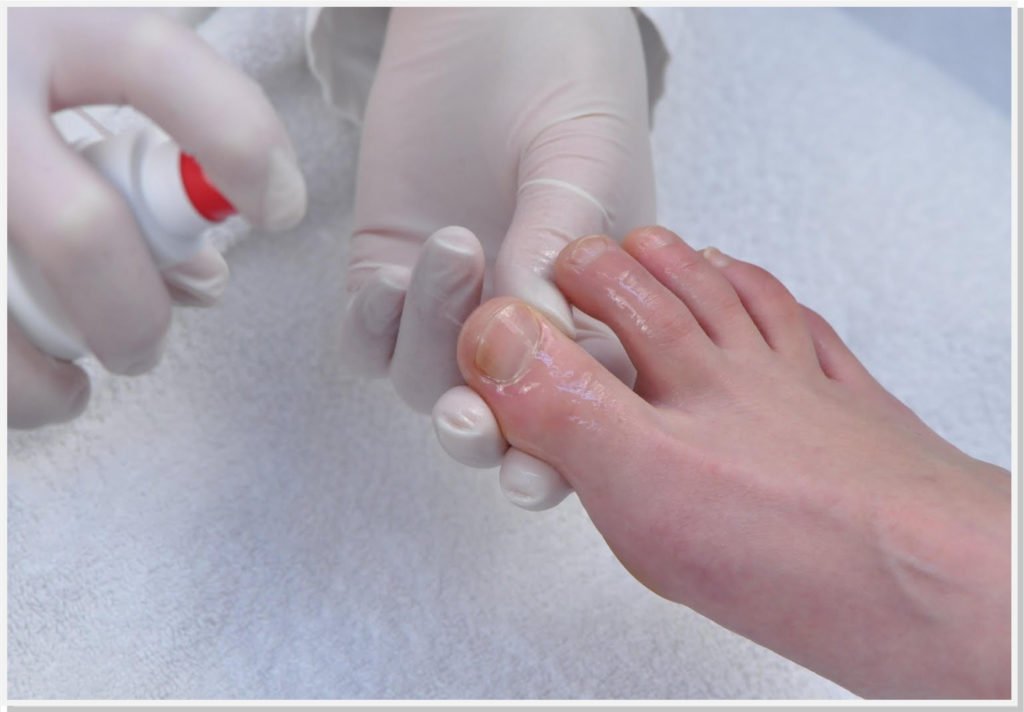 onicomicose-micose-unha-dermatologista-campinas-dra-cintia-volpini onicomicose-micose-unha-dermatologista-campinas-dra-cintia-volpini