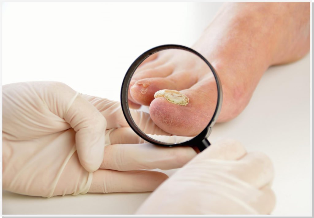 onicomicose-micose-unha-dermatologista-campinas-dra-cintia-volpini onicomicose-micose-unha-dermatologista-campinas-dra-cintia-volpini