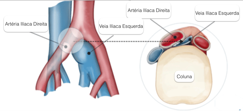 sindrome-de-cockett-dr-daniel-benitti-cirurgiao-vascular-sao-paulo-campinas sindrome-de-cockett-dr-daniel-benitti-cirurgiao-vascular-sao-paulo-campinas