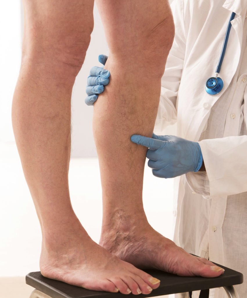 sindrome-de-cockett-tratamento-dr-daniel-benitti-cirurgiao-vascular-sao-paulo-campinas sindrome-de-cockett-tratamento-dr-daniel-benitti-cirurgiao-vascular-sao-paulo-campinas