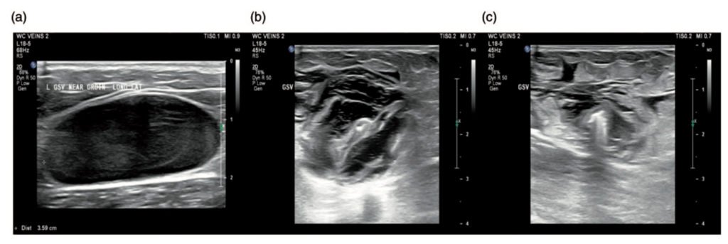 veia-safena-tratamento-dr-daniel-benitti-cirurgiao-vascular-sao-paulo-campinas veia-safena-tratamento-dr-daniel-benitti-cirurgiao-vascular-sao-paulo-campinas