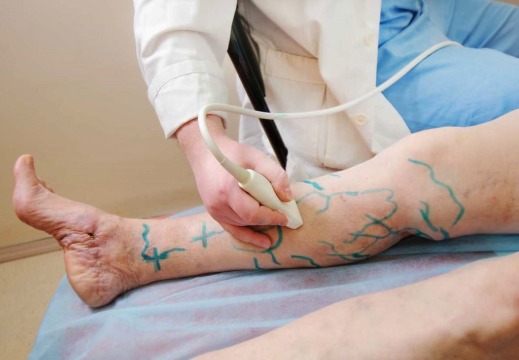 tratamento-varizes-vasinhos-alerta-dr-daniel-benitti-cirurgiao-vascular-sao-paulo-campinas tratamento-varizes-vasinhos-alerta-dr-daniel-benitti-cirurgiao-vascular-sao-paulo-campinas