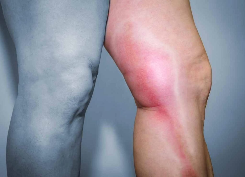 tromboflebite-causas-sintomas-tratamento-dr-daniel-benitti-cirurgiao-vascular-sao-paulo-campinas tromboflebite-causas-sintomas-tratamento-dr-daniel-benitti-cirurgiao-vascular-sao-paulo-campinas