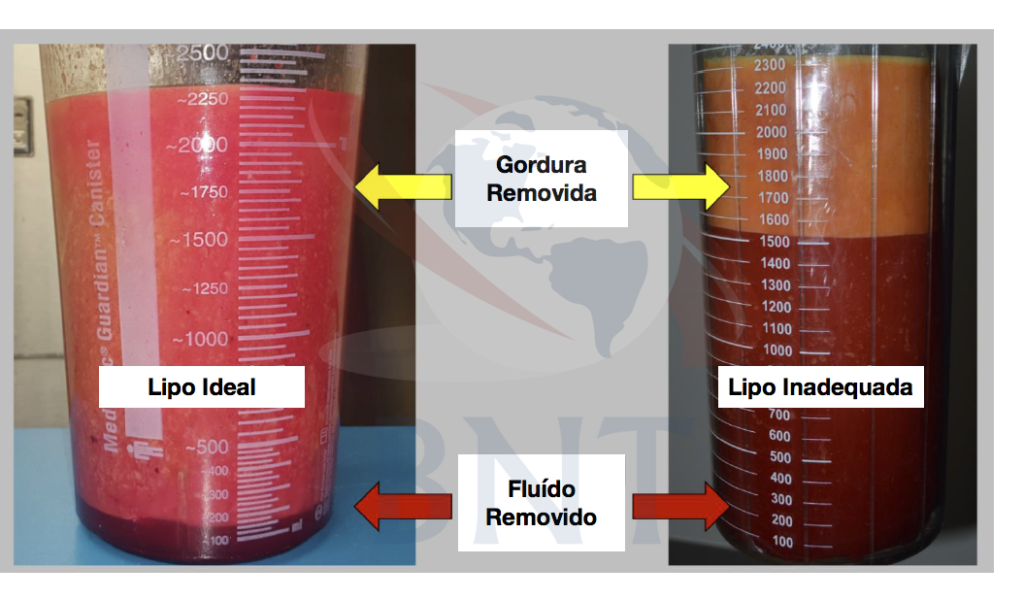 lipo-tratamento-lipedema-dr-daniel-benitti-cirurgiao-vascular-sao-paulo-campinas lipo-tratamento-lipedema-dr-daniel-benitti-cirurgiao-vascular-sao-paulo-campinas