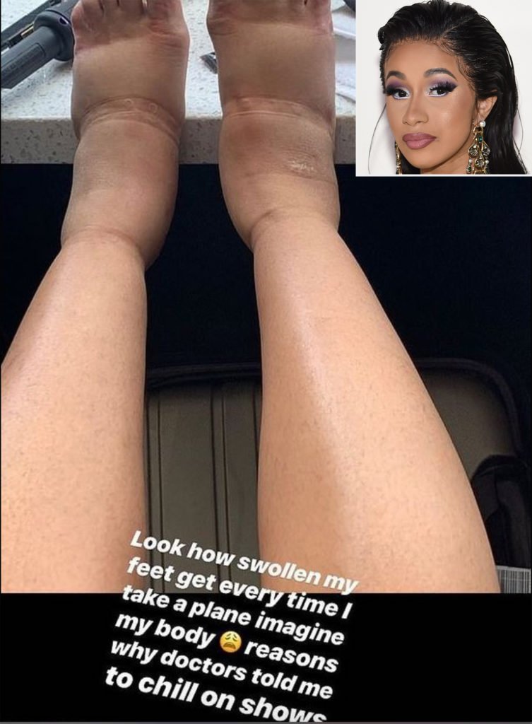 cardi-b-inchaço-voo-dr-daniel-benitti-cirurgiao-vascular-sao-paulo-campinas.jpg cardi-b-inchaço-voo-dr-daniel-benitti-cirurgiao-vascular-sao-paulo-campinas.jpg