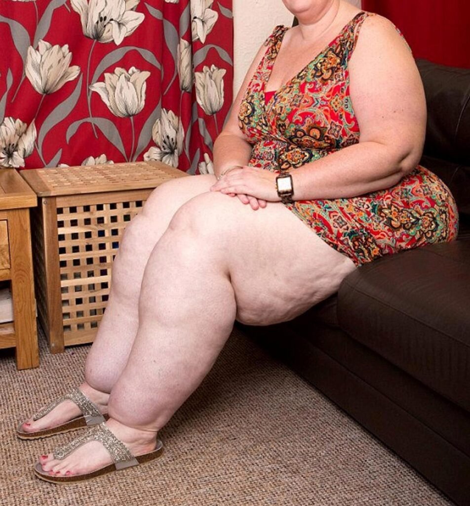 lipedema-artrite-dor-joelhos-quadris-dr-daniel-benitti-cirurgiao-vascular-sao-paulo-campinas lipedema-artrite-dor-joelhos-quadris-dr-daniel-benitti-cirurgiao-vascular-sao-paulo-campinas