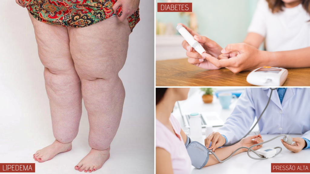 doencas-cronicas-lipedema-pressao-alta-diabetes-dr-daniel-benitti-cirurgiao-vascular-sao-paulo-campinas doencas-cronicas-lipedema-pressao-alta-diabetes-dr-daniel-benitti-cirurgiao-vascular-sao-paulo-campinas