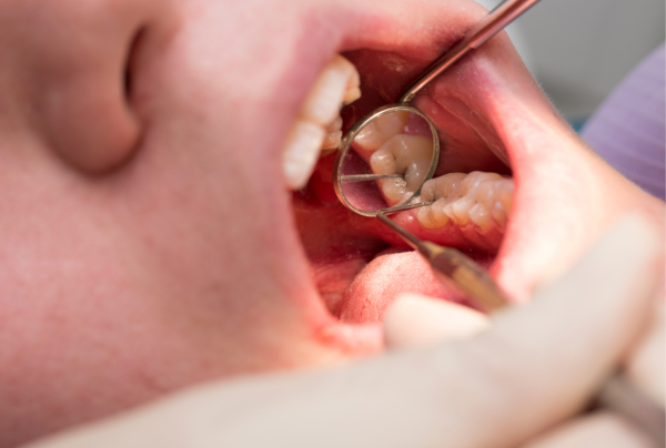caries-ma-alimentacao-dr-dr-daniel-benitti-medico-cirurgiao-vascular caries-ma-alimentacao-dr-dr-daniel-benitti-medico-cirurgiao-vascular