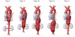 Aneurisma Tóraco-Abdoninal