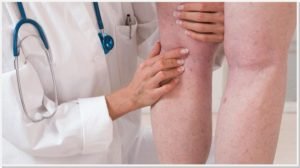 trombose-causas-genetica-dr-daniel-benitti-cirurgiao-vascular-campinas