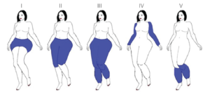 tipos-de-lipedema-dr-daniel-benitti-cirurgiao-vascular-sao-paulo-campinas