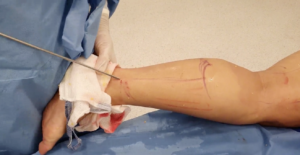lipoaspiracao-lipedema-dr-daniel-benitti-cirurgiao-vascular-sao-paulo-campinas