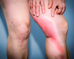 trombose-venosa-profunda-dr-daniel-benitti-cirurgiao-vascular-sao-paulo-campinas