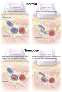 ultrassom-trombose-venosa-profunda-dr-daniel-benitti-cirurgiao-vascular-sao-paulo-campinas