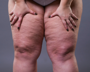 perguntas-comuns-lipedema-dr-daniel-benitti-cirurgiao-vascular